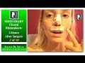 Closed Rhinoplasty Video Diary-  5 Hours After Surgery, 2 of 10