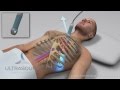 How to obtain: Parasternal Long Axis Ultrasound View - Training and Techniques - ICU