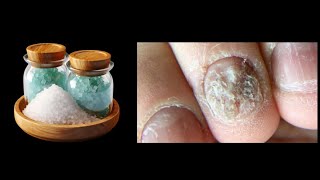 just 1 tablespoon of sea salt and I am rid of nail fungus forever.The best natural remedy! 💯 result