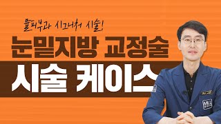 '레이저 눈밑지방 교정술' 시술 케이스 알려드립니다  |  뮬피부과