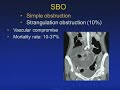 Acute Mesenteric Ischemia: MDCT Evaluation-- Jay Heiken, MD (SCBT-MR/SABI 37th Annual Conference)