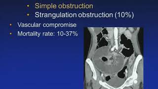 Acute Mesenteric Ischemia: MDCT Evaluation-- Jay Heiken, MD (SCBT-MR/SABI 37th Annual Conference)