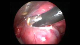 Coblation Assisted Excision of oropharyngeal Mass