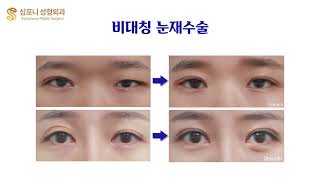 ★Revision Blepharoplasty : Before \u0026 After★ Symphony Plastic Surgery Korea - Complex Cases