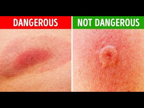How To Identify Common Bug Bites Youtube How To Identify Common Bug Bites Youtube