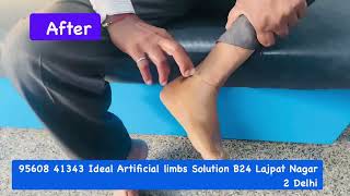 amputee leg07835880155 Partial foot amputation | Silicone cosmetic foot prosthesis | natural look 😊