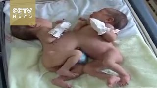 Chinese doctors successfully separate conjoined twins