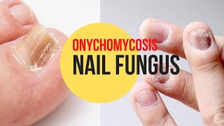 🦶 Get rid of Nail Fungus / Onychomycosis with these 13 Natural Remedies