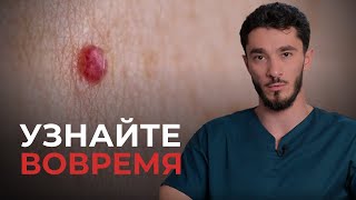 Родинки: Безобидные пятна или скрытая угроза? Узнайте, как защитить себя от РАКА!