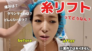 【美容】糸リフトのリアルな感想です。