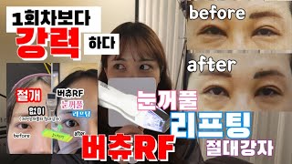 닥터울버린(Dr.ulverin) | 요즘 너무 핫하다‼️ 버츄RF , 눈꺼풀리프팅의절대강자  .. 그효과는?