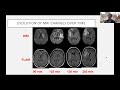 management of acute stroke