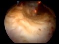 bladder tumor transurethral resection _2