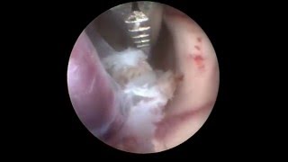 Endoscopic Colloid Cyst Resection