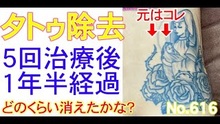 【ピコレーザー】5回の治療でここまで消えた！この後どうする！？レーザーによるタトゥー除去616【エンライトン】