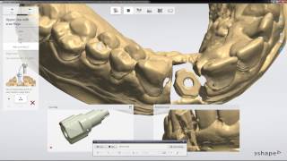 Digital Implant Scanning Workflow in 3Shape