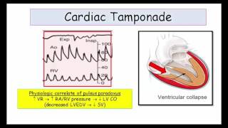 12DaysinMarch, Tamponade and Constrictive Pericarditis for USMLE Step One (Part II)