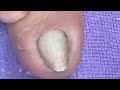 Extremely infected and sharp nail