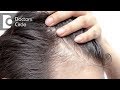 What causes hair loss in teenagers when parents have good density hair?-Dr. Aruna Prasad