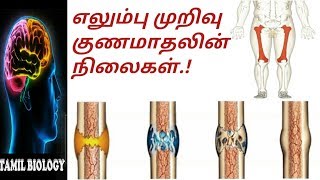 எலும்பு முறிவு குணமாகுதல் நிலைகள்  | Healing of fracture | TAMIL BIOLOGY