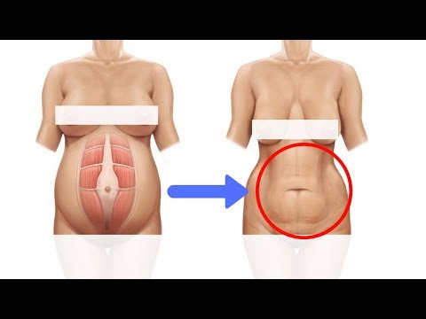 How To Tighten Loose Skin After Pregnancy How To Tighten Loose Skin After Pregnancy