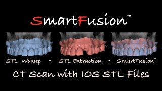 Intraoral scan for implant planning