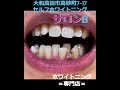 セルフホワイトニング　before after ①