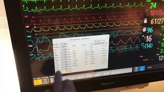 PA catheter shooting numbers in the ICU