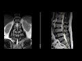 vertebra transicional lumbosacra en rm lumbarizacion de s1 vs sacralizacion l5