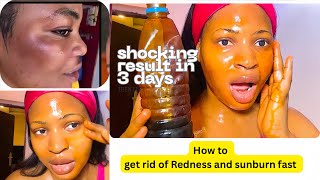 Get rid of sunburn and Redness fast /Natural at home remedy effective 3 days shocking result