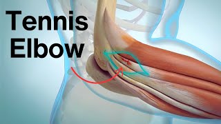 Tennis Elbow Explained: Symptoms, Causes, Treatment \u0026 Surgery (Medical Animation)