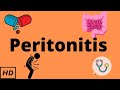 Peritonitis, Causes, Signs and Symptoms, Diagnosis and Treatment.