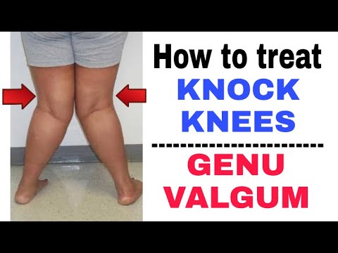 How To Fix Knock Knees/Genu Valgum | Knock Knees Exercises At Home | Dr ...