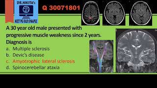 Amyotrophic lateral sclerosis