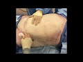 dr. repta performs large volume liposuction