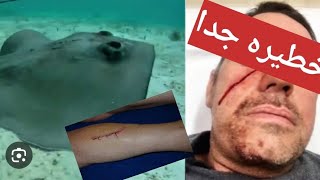 ضربة سمكة الراي لا ترحم. Stingray accident