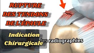 Rupture des Tendons de l'épaule indication chirurgicale Tendinite Coiffe des Rotateurs Traumatique