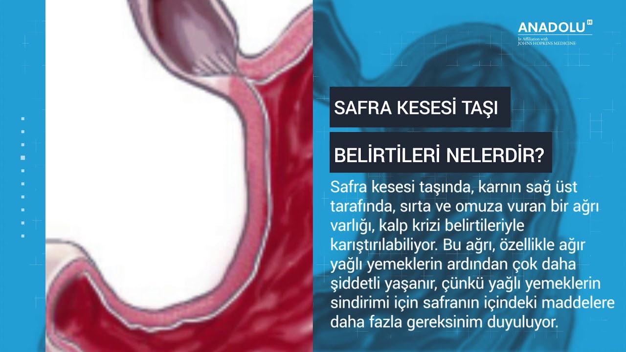 Safra Kesesi Taşı Ve Tedavisi - YouTube