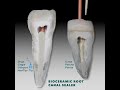 delivering mtapex™ bioceramic root canal sealer