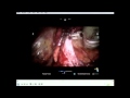 Robotic Assisted Single Incision Laparoscopic Total Extraperitoneal Bilateral Inguinal Hernia Repair