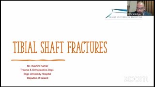 Tibial Shaft Fractures ( Mr. Ibrahim Kamar )