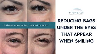 How Bags Under Eyes When Smiling can be Treated