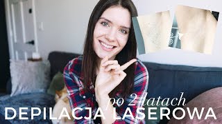 Depilacja Laserowa po 2 latach od ostatniego zabiegu! | Laser Thunder MT vs Vectus