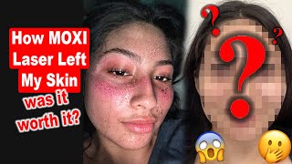 Moxi Laser to Target Dark Spots and Wrinkles (FIRST TIME--PAINFUL!!)