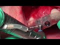 Computer Guided Implant Placement 2 (Adin) , after GBR - by Dr Bernard Dahan