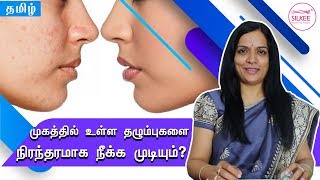 பரு / விபத்தினால் ஏற்பட்ட தழும்புகள் மறைய சிறந்த வழி எது? | Silkee Cosmetology Clinic | Dr sreelatha