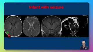 Tuberous Sclerosis