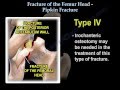 Fractures Of The Femur Head ,Pipkin Fracture - Everything You Need To Know - Dr. Nabil Ebraheim