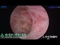 raykeen holmium laser holep performed by prof. liu chunxiao southern medical university china.