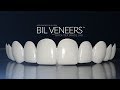 Bil Veneers -The World's Finest Designer for Online Dental Veneers by Brighter Image Lab